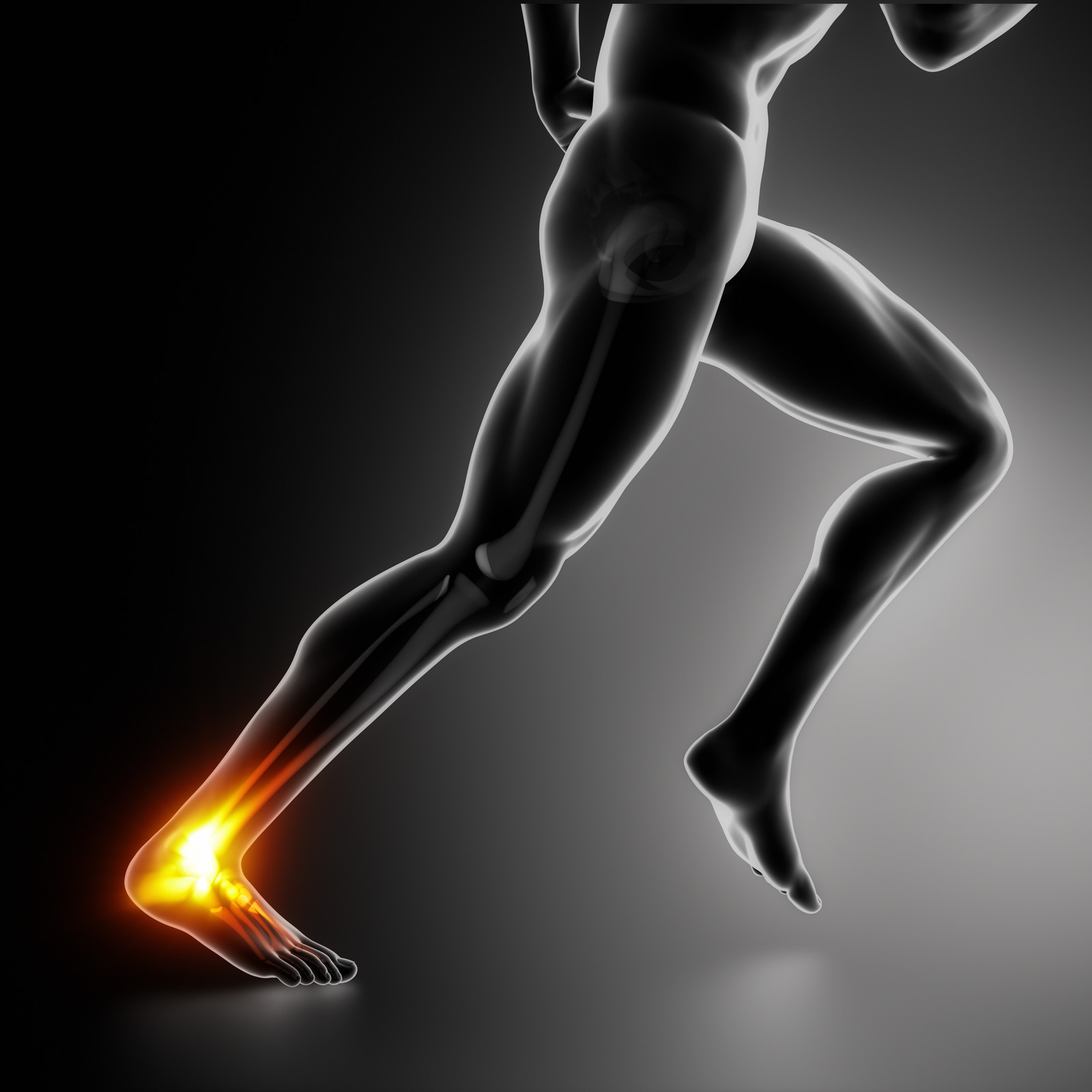 How To Beat Achilles Tendonitis – Sports Performance Physical Therapy