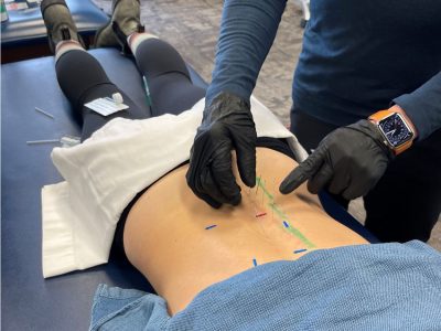 What Is Dry Needling?